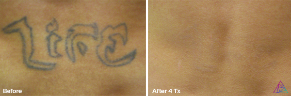 Before and after tattoo removal